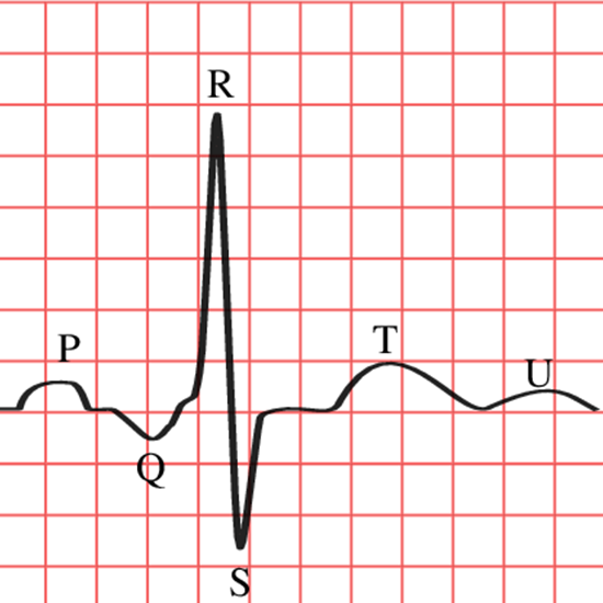 ecg long lead ii (electrocardiogram) test